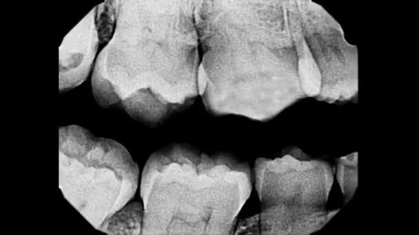 Nsan Dişlerinin Röntgen Görüntüsünü Durdurun Diş Dolgusu Taraması Diş Sinirlerinin — Stok video