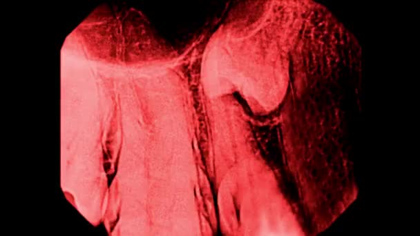 人間の歯X線またはCtスキャンホラーコレクションの動きを停止します 顎の赤い体の部分 血まみれの歯 怖いハロウィーンの背景 — ストック動画