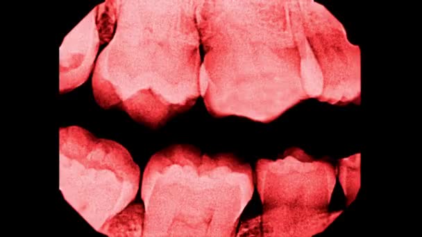 Остановить Движение Человеческих Зубов Рентгеном Сканирования Коллекции Ужасов Красные Части — стоковое видео