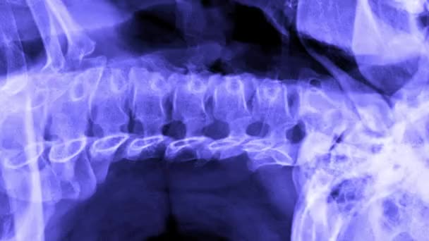 ボディパーツCtまたはX線スキャン ヒト脊椎肩 頭蓋骨の一部 ホラーコレクションの動きを停止します 人間の頭蓋骨 肋骨と胸関節 脊椎骨が付いている首 ハロウィーンの背景 — ストック動画