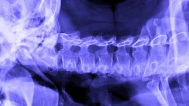 MRI insan boyun taraması seti, çenenin, boyun ve omuzların bir kısmının manyetik rezonans görüntülemesi. BT taramasının hareketli görüntüsünü anatomik detaylarla durdur. Kusursuz döngü.