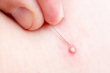Sivilce, sivilce ya da komedi. İltihaplı sivilceler, sivilceler, kistler. Deri enfeksiyonu. Sivilce patlaması. İltihaplı elementler, patlamalar, sivilce lezyonları, sivilce oluşumları, sivilce döküntüleri. Tıbbi klinik. Cilt bakımı