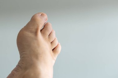 Ayak tırnağı enfeksiyonunu gösteren bir ayak, tıbbi tedavi ihtiyacını vurguluyor