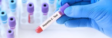Doktor, tıbbi test tüplerinin arka planında hepatit C virüsü (HCV) olan bir test tüpü tutuyor. Pankart