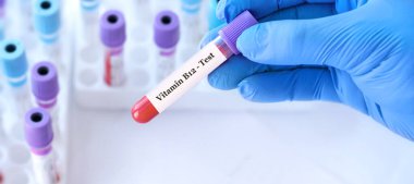 Analizli tıbbi test tüplerinin arka planında B12 vitamini testi olan bir test tüpü tutan doktor.