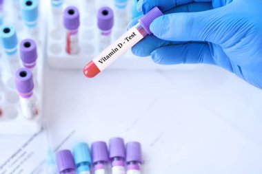 Doctor holding a test blood sample tube with Vitamin B12 test on the background of medical test tubes with analyzes
