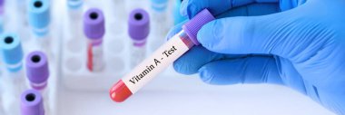 Analizli tıbbi test tüplerinin arka planında A vitamini testi olan bir test tüpü tutan doktor..