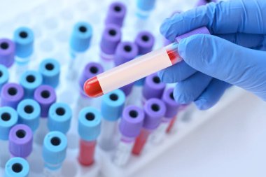 Hand with medical glove of doctor holds test tube with blood sample and blank label for own text on the background of medical test tubes.