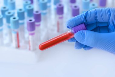 Doktorun eldiveni ile birlikte tıbbi test tüplerinin arka planında kan örneği olan bir test tüpü bulunduruyor..