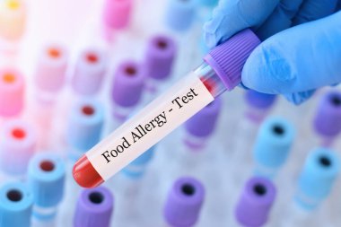 Analizli tıbbi test tüplerinin arka planında gıda alerjisi testi olan bir test tüpü tutan doktor.