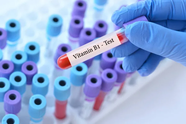 stock image Doctor holding a test blood sample tube with Vitamin B1 test on the background of medical test tubes with analyzes.Banner.Copy space for text