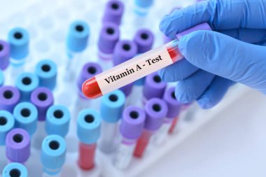 Analizli tıbbi test tüplerinin arka planında A vitamini testi olan bir test tüpü tutan bir doktor. Metin için alanı kopyala