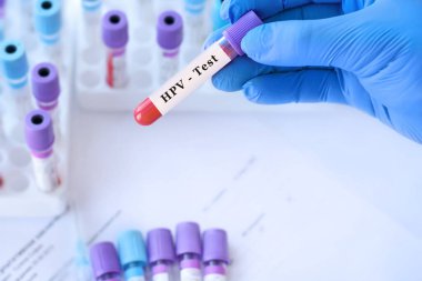 Analizli tıbbi test tüplerinin arka planında HPV testi olan bir test tüpü tutan doktor..