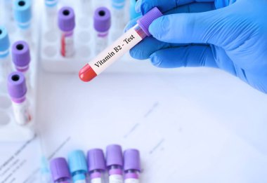 Analizli tıbbi test tüplerinin arka planında B2 vitamini testi olan bir test tüpü tutan doktor..