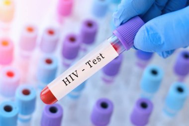Doktorun eli, test tüplerinin arka planında kan ile test tüpü tutuyor. Kan örneği ve HIV testi.