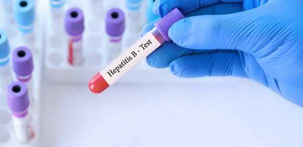 Лікар Тримає Пробірку Крові Вірусом Гепатиту Hbv Задньому Плані Пробірки — стокове фото