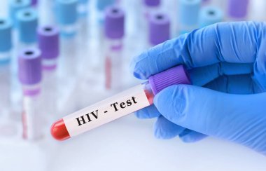 Doktorun eli, test tüplerinin arka planında kan ile test tüpü tutuyor. Kan örneği ve HIV testi.