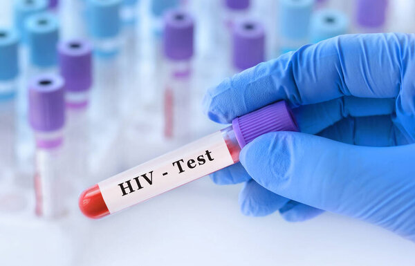 Doctor's hand holds test tube in blood on the background of test tubes with analyzes.Blood sample with HIV testing