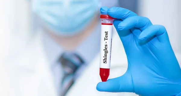 Médico Sosteniendo Tubo Muestra Sangre Positivo Con Prueba Herpes Zóster — Foto de Stock