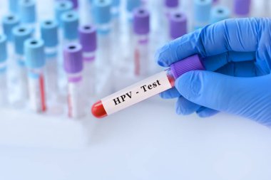 Analizli tıbbi test tüplerinin arka planında HPV testi olan bir test tüpü tutan doktor..