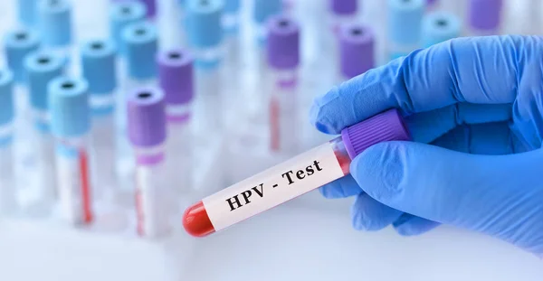 Doctor Holding Test Blood Sample Tube Hpv Test Background Medical — Stock Photo, Image