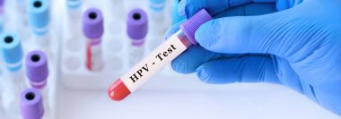 Analizli tıbbi test tüplerinin arka planında HPV testi olan bir test tüpü tutan doktor..