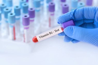 Analizli tıbbi test tüplerinin arka planında B2 vitamini testi olan bir test tüpü tutan doktor.