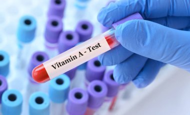 Analizli tıbbi test tüplerinin arka planında A vitamini testi olan bir test tüpü tutan bir doktor. Metin için alanı kopyala