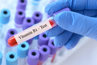 Doktorun elinde analiz edilen tıbbi test tüplerinin arka planında B1 vitamini testi olan bir test kan örneği tüpü var.