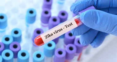 Analizli tıbbi test tüplerinin arka planında Zika virüsü testi olan bir test tüpü tutan doktor..