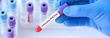 Analizli tıbbi test tüplerinin arka planında Astrovirüs PCR testi olan bir test tüpü tutan doktor..