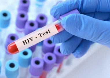 Doktorun eli, test tüplerinin arka planında kan ile test tüpü tutuyor. Kan örneği ve HIV testi.