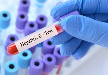 Doktor, tıbbi test tüplerinin arka planında hepatit B virüsü (HBV) olan bir test tüpü tutuyor.