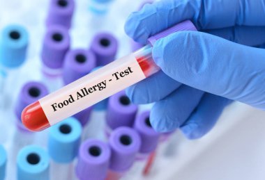 Analizli tıbbi test tüplerinin arka planında gıda alerjisi testi olan bir test tüpü tutan doktor.