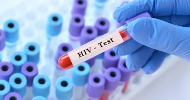 Doktorun eli, test tüplerinin arka planında kan ile test tüpü tutuyor. Kan örneği ve HIV testi.