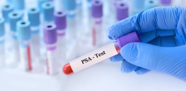 Doktorun elinde PSA Prostat Özel Antijen testi olan bir test tüpü var. Analizli tıbbi test tüplerinin arka planında.