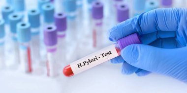 Analizlerle tıbbi test tüplerinin arka planında H. Pylori (IgA, IgG ve IgM) ile birlikte bir test tüpü tutan doktor.