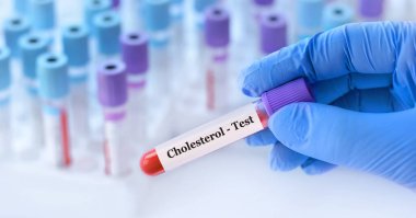 Analizli tıbbi test tüplerinin arka planında kolesterol testi olan bir test tüpü tutan doktor.