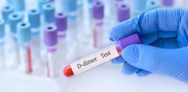 Analizli tıbbi test tüplerinin arka planında D-dimer testi olan bir test tüpü tutan doktor..
