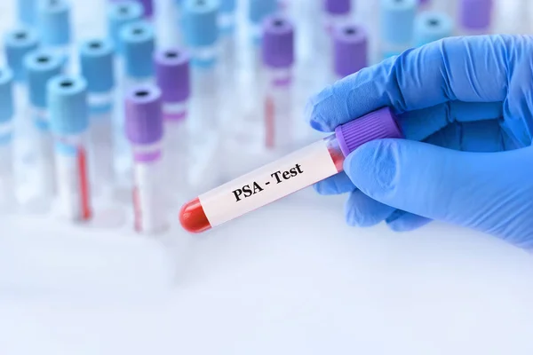 Doktorun elinde PSA Prostat Özel Antijen testi olan bir test tüpü var. Analizli tıbbi test tüplerinin arka planında.