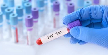 Tıbbi test tüplerinin arka planında Epstein-Barr Virüsü (EBV) ile analiz edilmiş bir test tüpü tutan doktor.