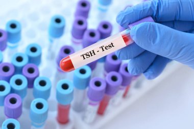 Tıbbi test tüplerinin arka planında tiroid uyarıcı hormon (TSH) testine tabi tutulan ve analiz edilen bir test tüpü tutan doktor.