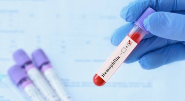 Analizli tıbbi test tüplerinin arka planında pozitif hemofili testi olan bir test tüpü tutan doktor..