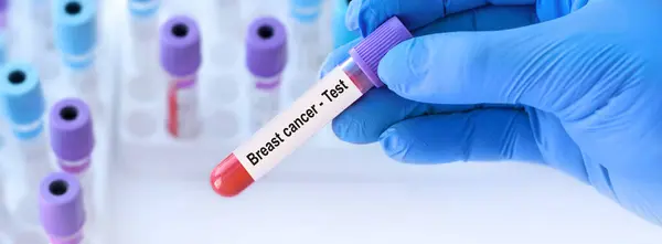 stock image Doctor holding a test blood sample tube with breast cancer test on the background of medical test tubes with analyzes.