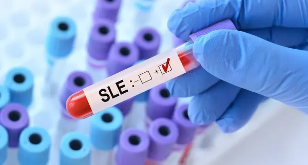 stock image Doctor holding a test blood sample tube with Systemic Lupus Erythematosus (SLE) on the background of medical test tubes with analyzes.