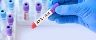 Doktor, tıbbi test tüplerinde KP2 virüsünün tespiti için bir test tüpü tutuyor. KP2, FliRT varyantlarından biri. FLiRT semptomları omikron ile aynıdır.