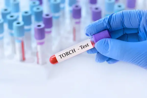 Stock image Doctor holding a test blood sample tube with TORCH Panel (Toxoplasma, Rubella, Cytomegalovirus, Herpes simplex) test on the background of medical test tubes with analyzes