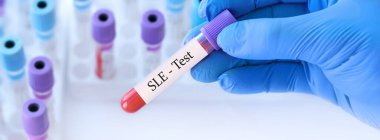 Tıbbi test tüplerinin arka planında analizlerle birlikte Sistemli Lupus Erythematosus (SLE) ile test edilmiş kan örneği tüpü tutan doktor..