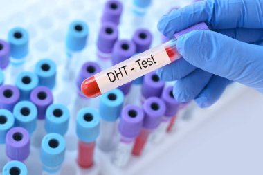 Analizli tıbbi test tüplerinin arka planında DHT hormon testi olan bir test tüpü tutan doktor..