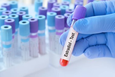 Analizli tıbbi test tüplerinin arka planında östradiol testi olan bir test tüpü tutan doktor..